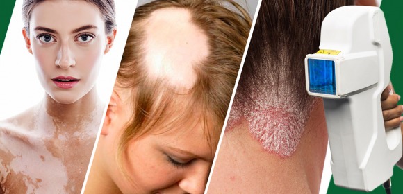 Technologia excimerowa